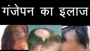 'Stop hair fall in 10days | Regrow Hair with Special Diet | Hindi'