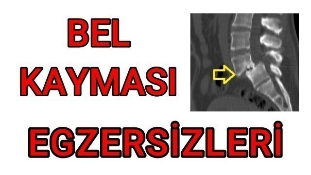 'BEL KAYMASI EGZERSİZLERİ / SPONDİLOLİSTEZİS / BEL KAYMASI NASIL DÜZELİR / Fzt Aynur BAŞ'