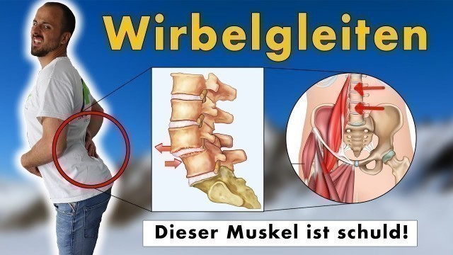 'Gleitwirbel, Wirbelgleiten wegtrainieren | GENAUE Ursache und 1 Übungen die NACHHALTIG hilft'